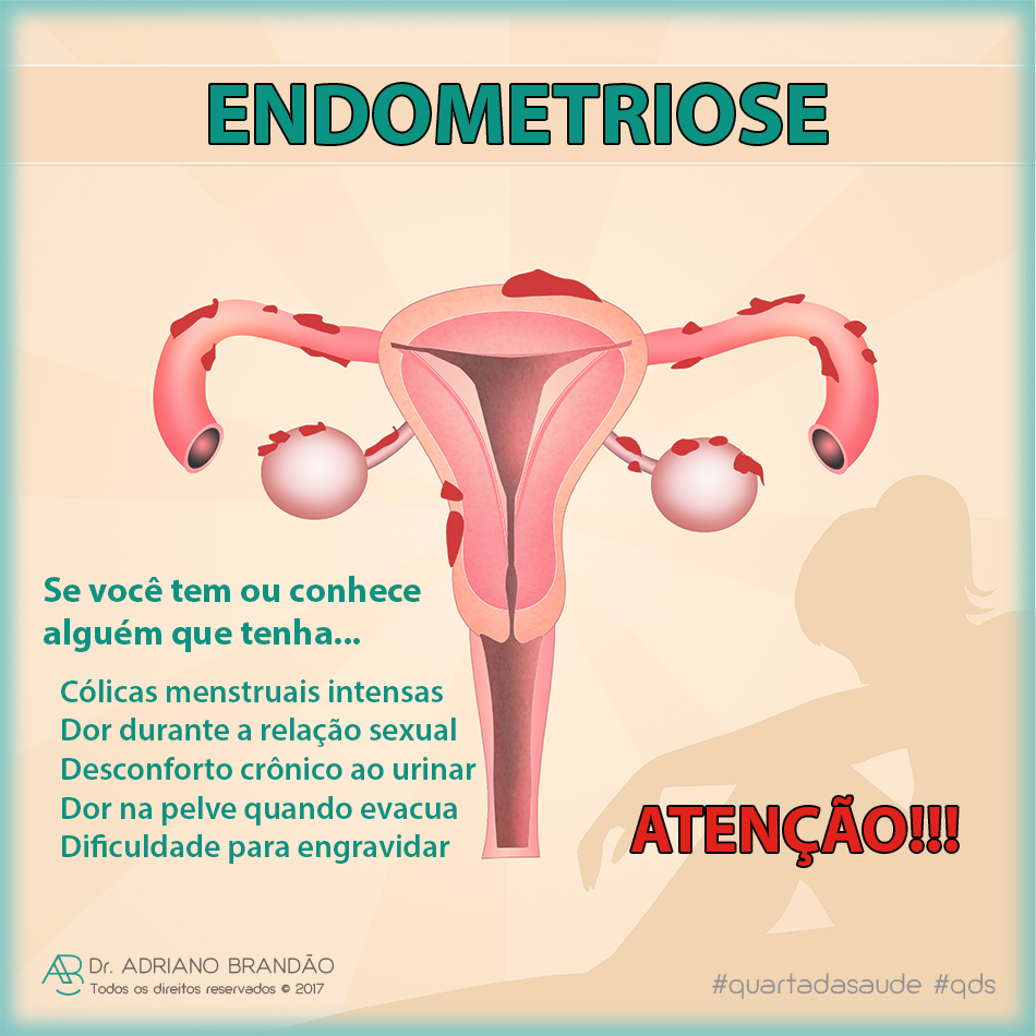 Sintoma De Endometriose Sangue Menstrual Com Coágulos Sanguíneos